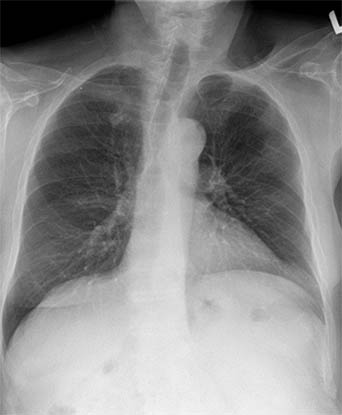 Std CXR